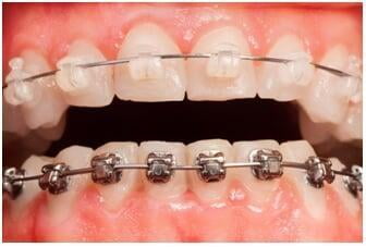 ITS Dental Hospital Self Ligating Braces