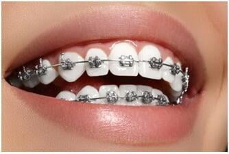 ITS Dental Hospital  Metal Braces