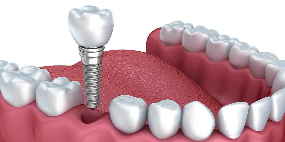 ITS Dental Hospital Dental implants replace missing teeth
