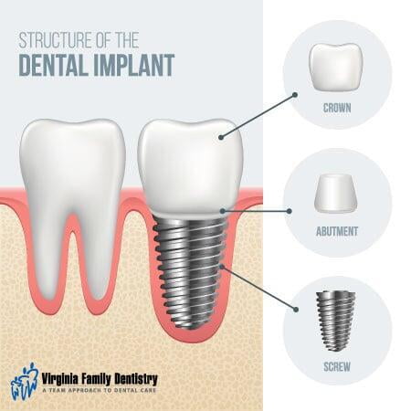 ITS Dental Hospital teeth implants