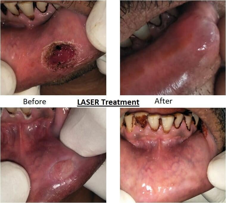ITS Dental Hospital Laser Treatment
