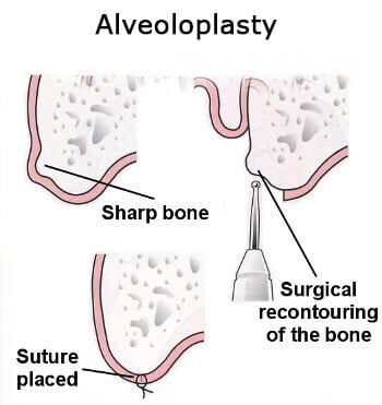 ITS Dental Hospital Alveoloplasty