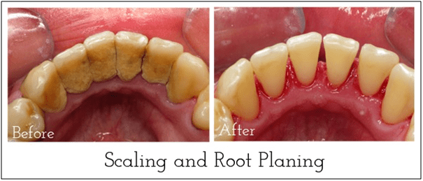 ITS Dental Hospital Scaling and Root Planing