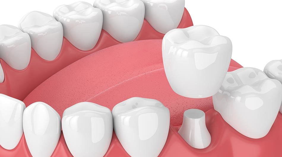 ITS Dental Hospital Dental crowns