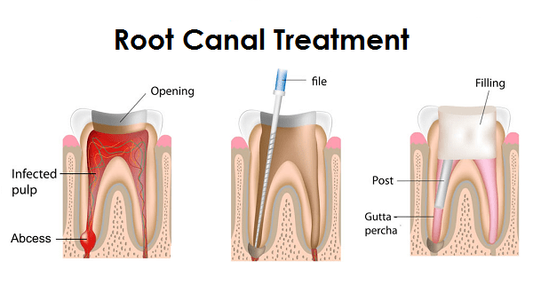 ITS Dental Hospital Root Canan Treatment