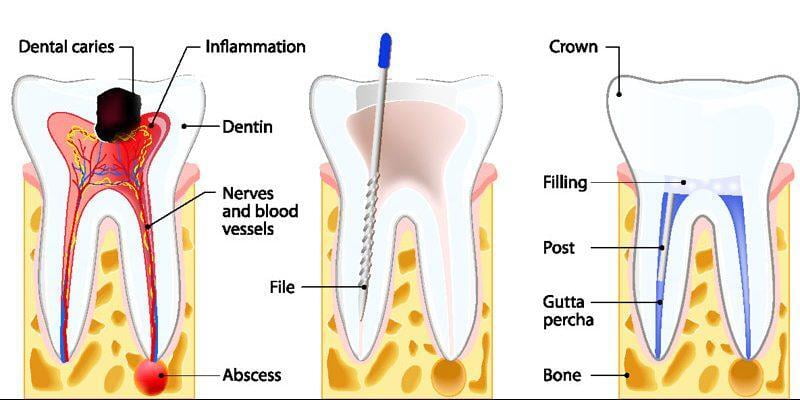ITS Dental Hospital Root Canal Treatment Infographics