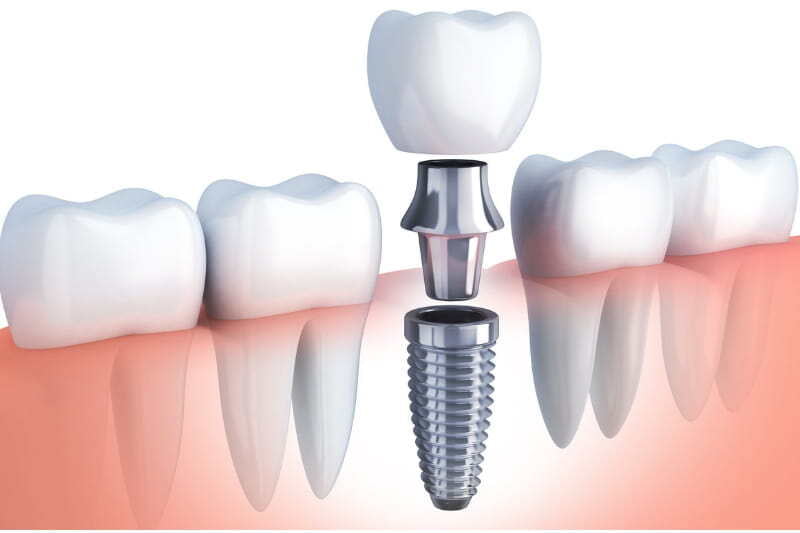 ITS Dental Hospital Implant Improvements