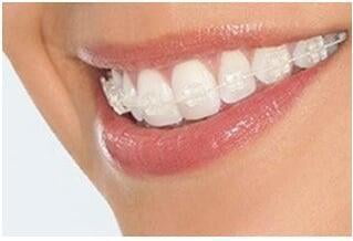 ITS Dental Hospital Ceramic Braces