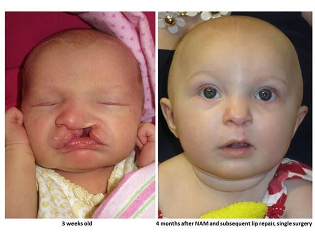 ITS Dental Hospital Cleft Lip and Palate Surgeries