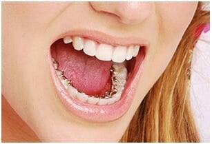 ITS Dental Hospital Lingual Braces