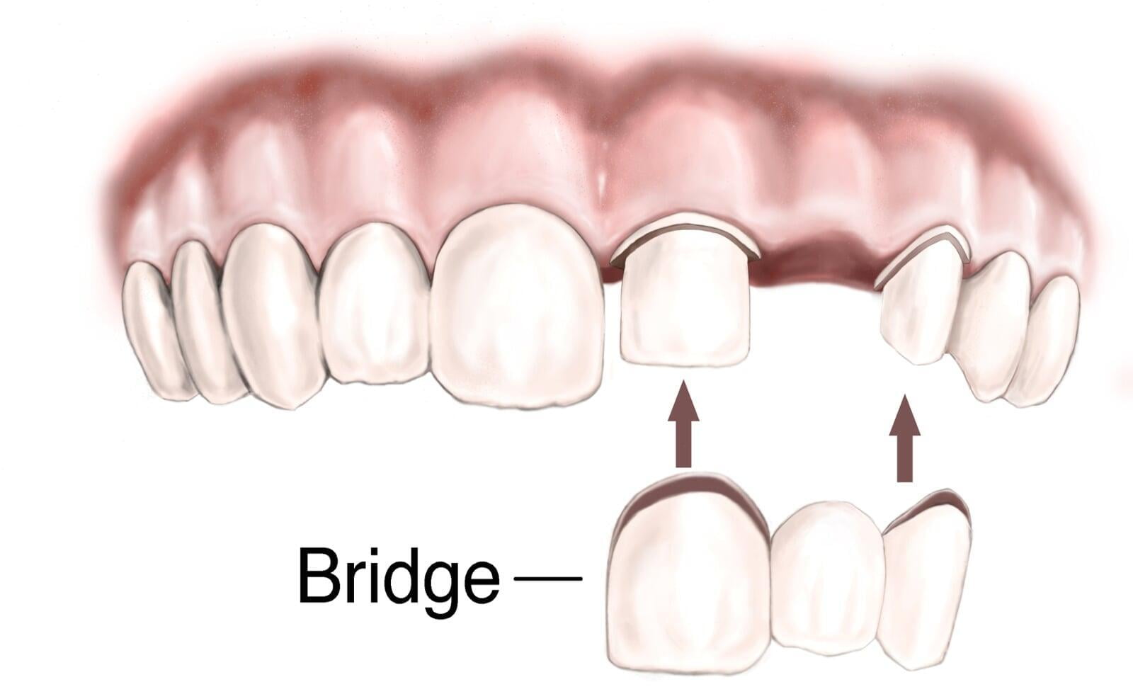 ITS Dental Hospital fixed partial dentures