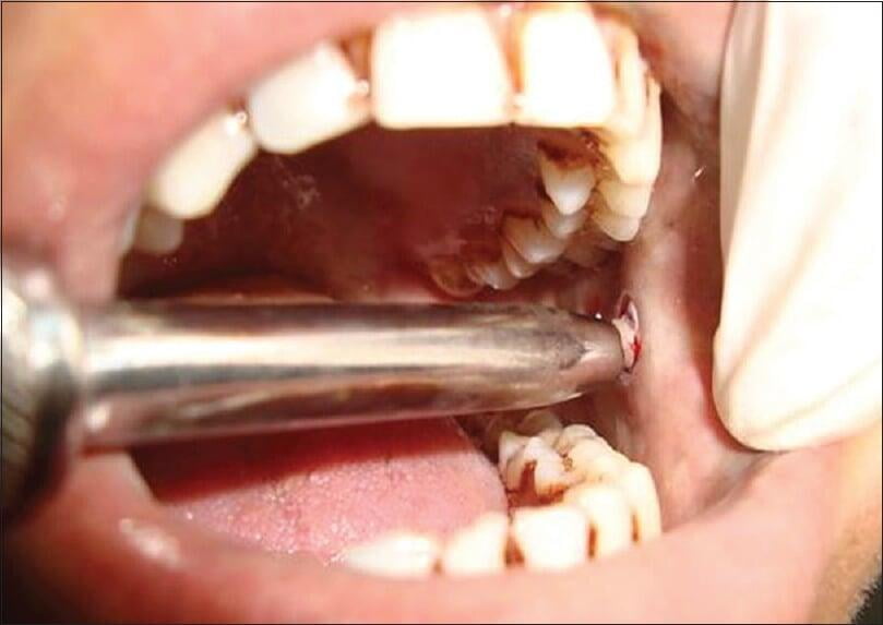 ITS Dental Hospital Cytology and Biopsy