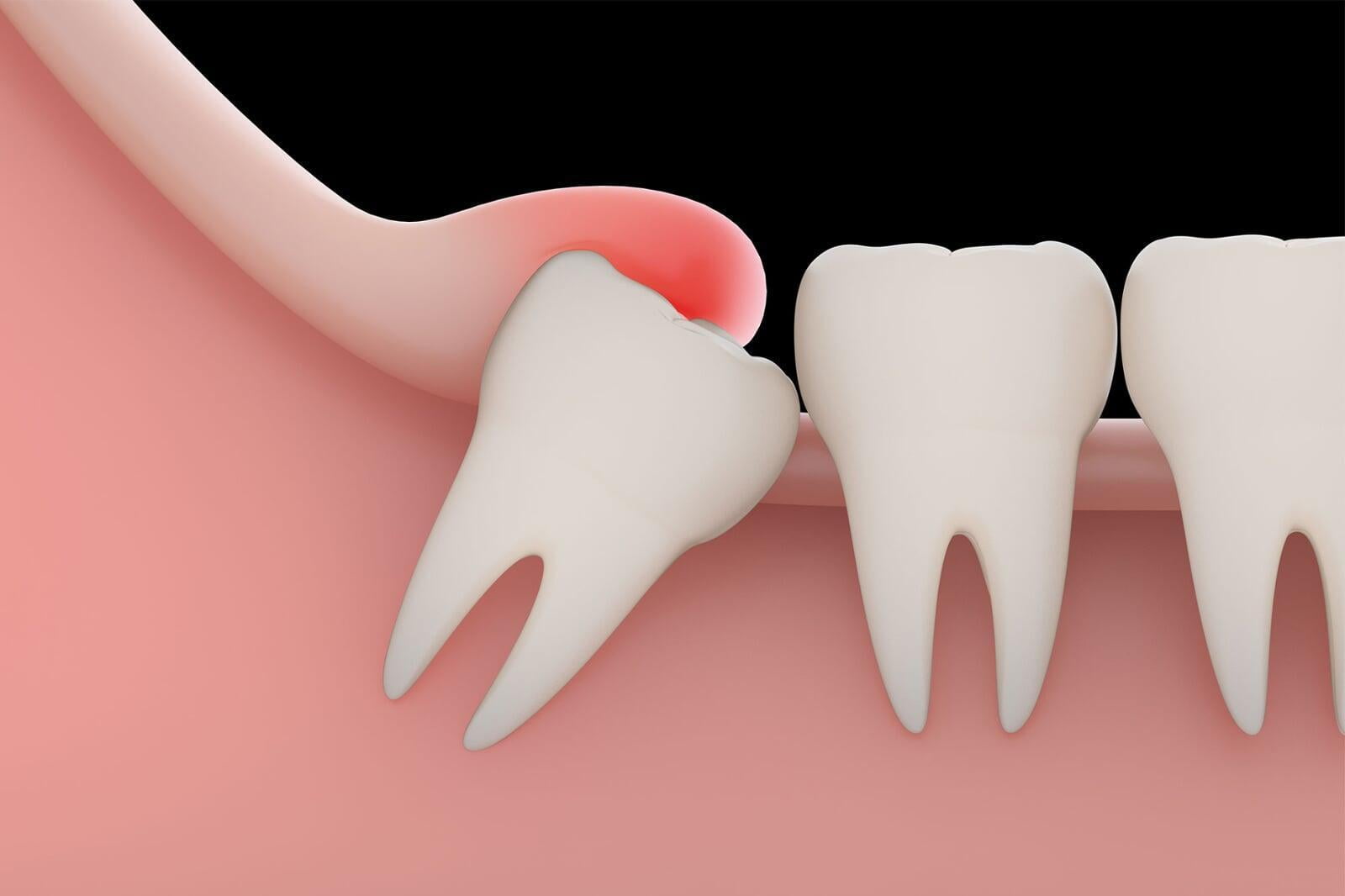 ITS Dental Hospital Extraction Of Impacted Tooth