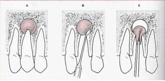 ITS Dental Hospital Enculeation Of Cyst