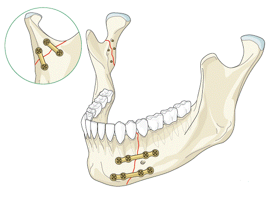 ITS Dental Hospital Trauma Cases Fracture