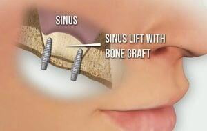 ITS Dental Hospital Sinus Lift Procedures
