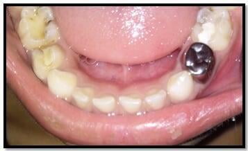 ITS Dental Hospital Stainless Steel Crowns