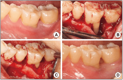 ITS Dental Hospital Flap Surgery