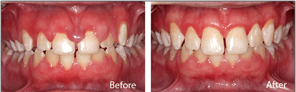 ITS Dental Hospital Gingivectomy