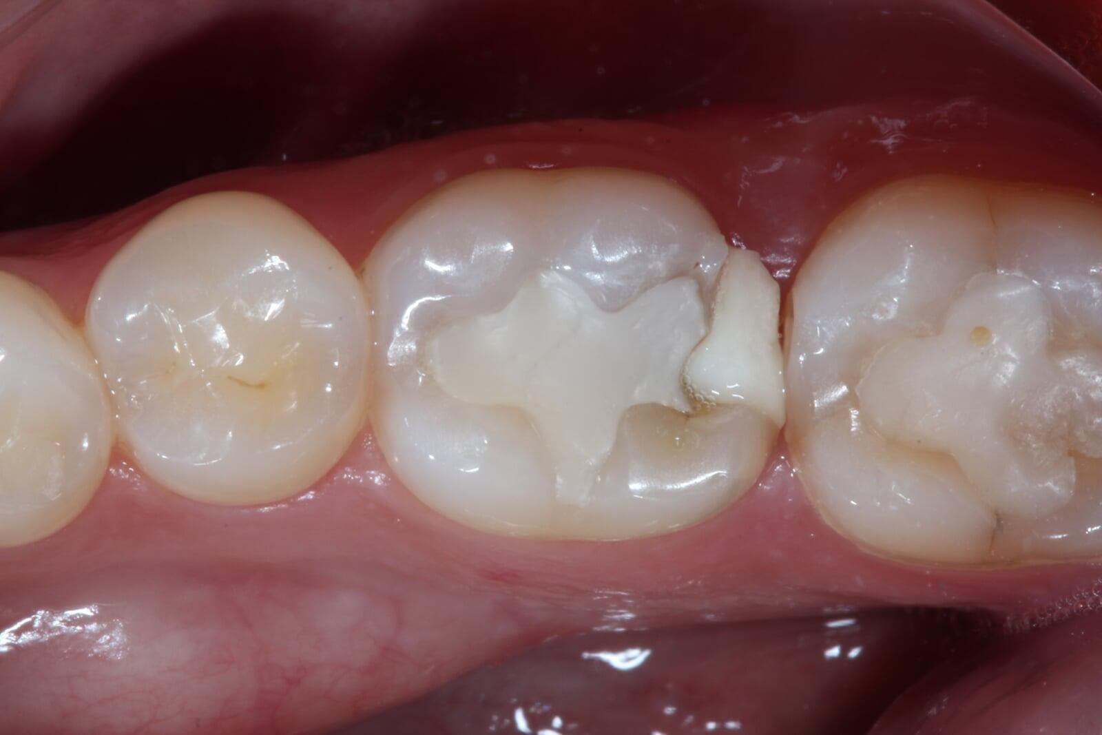 ITS Dental Hospital Composite Restorations