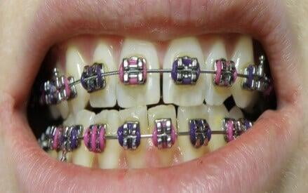 iTS Dental College Metal Braces