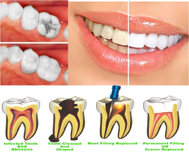 ITS Dental Hospital Conservative Dentistry