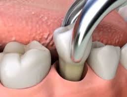 ITS Dental Hospital Oral and Maxillofacial Surgery