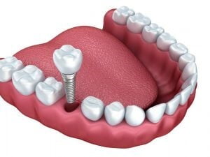 WHAT ARE DENTAL IMPLANTS?