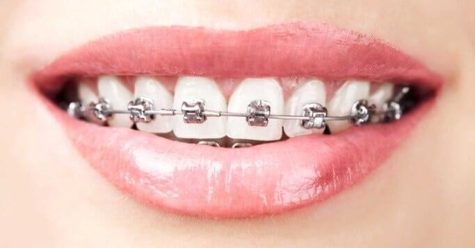 iTS Dental College Self Ligating Braces