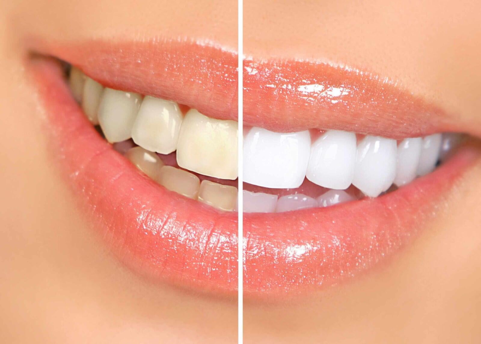 ITS Dental Hospital Teeth Whitening